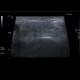Acute parotitis: US - Ultrasound